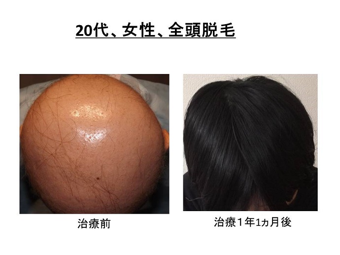 円形脱毛症　病院